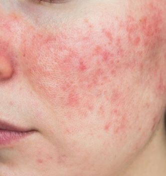 Rosacea Treatment