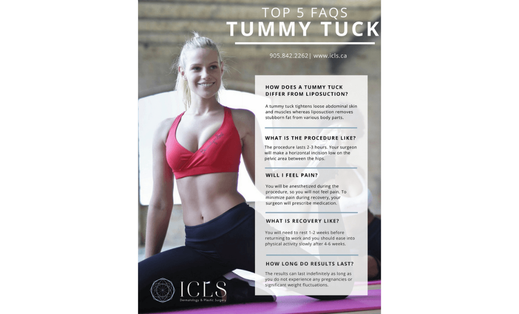 Top 5 FAQ's for a Tummy Tuck - ICLS Dermatology & Plastic Surgery