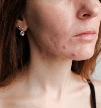 Acne Scarring