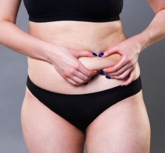 Woman before Liposuction