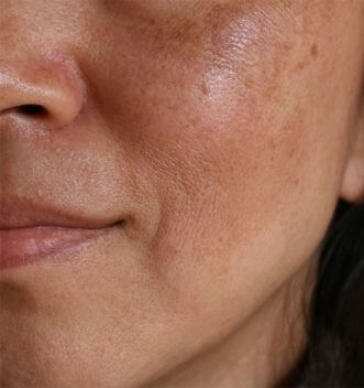 Melasma