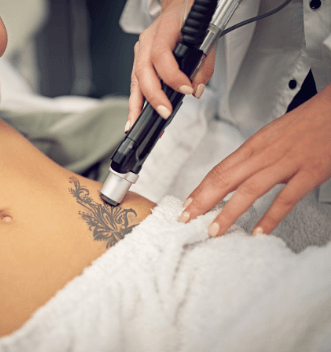 Laser Tattoo Removal