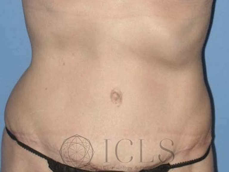 before and after mini tummy tuck recovery