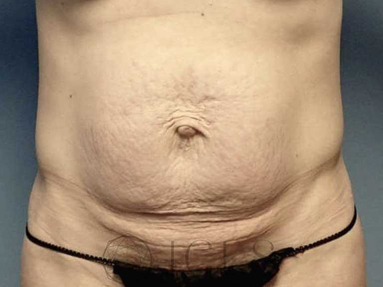 Tummy Tuck (Abdominoplasty) Mississauga Toronto ON