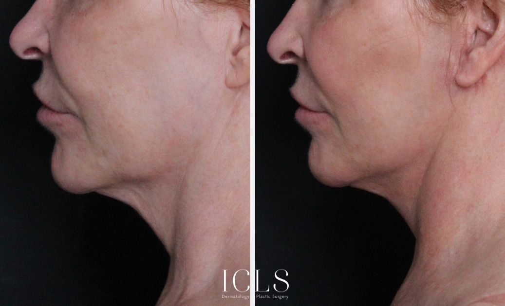 Get A Chiseled Jawline Without Surgery