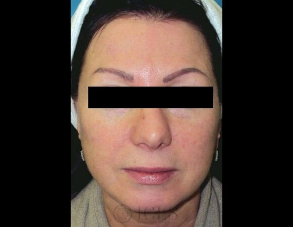 After facelift: The same woman with smoother skin, tighter jawline, and reduced signs of aging.