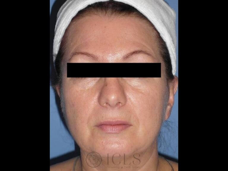 Before facelift: A woman with sagging skin and visible signs of aging around the jawline and cheeks.