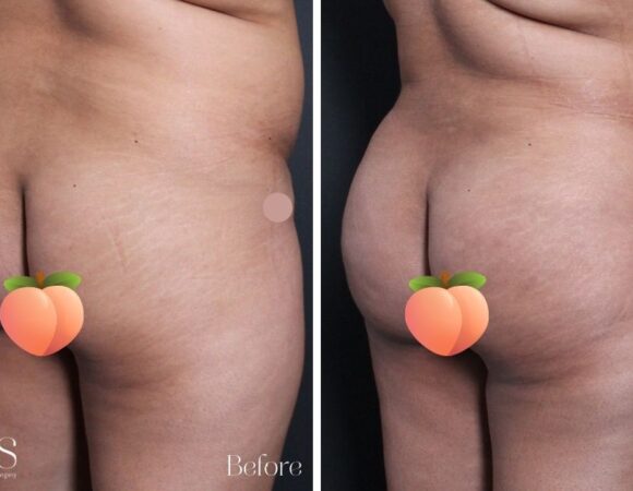 BBL bum lift ICLS Dermatology and Plastic Surgery