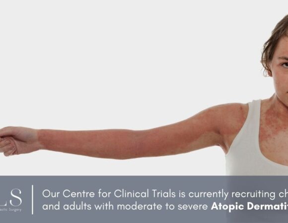 ICLS Clinical Trial eczema children adults