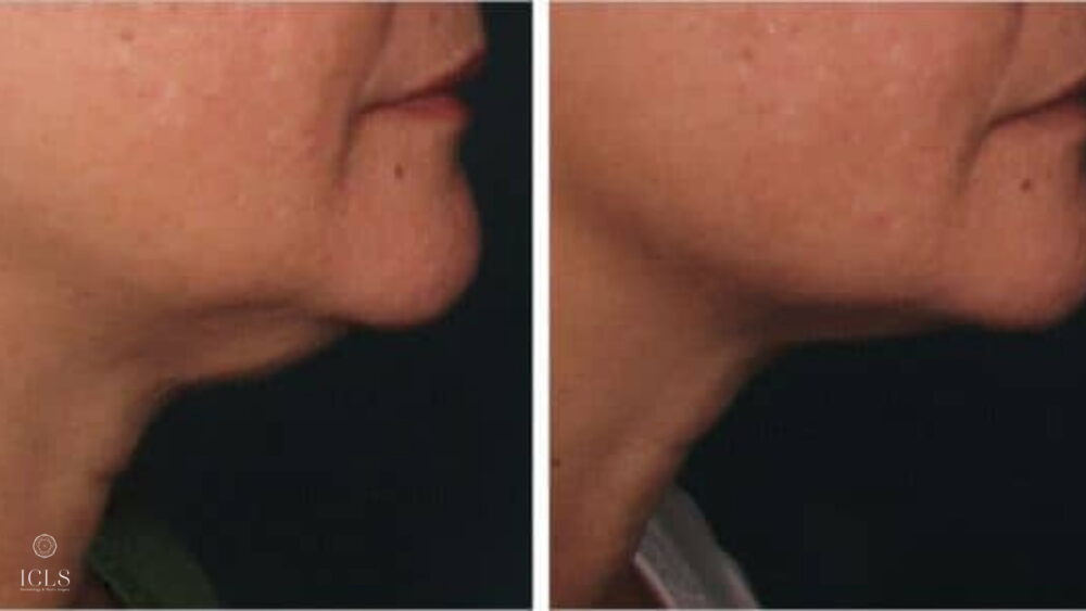 ultherapy treatment before and after results