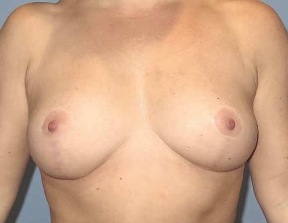 Photo 14 of after Breast implant removal and mastopexy in Toronto.