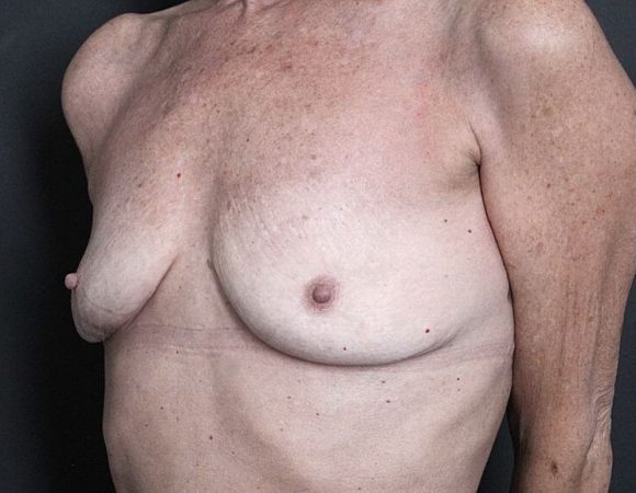Photo 2 of After Breast Implant Removal in Toronto.