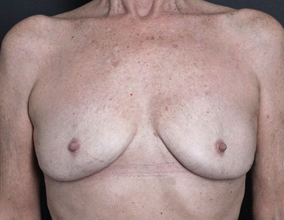 Photo 4 of After Breast Implant Removal in Toronto.