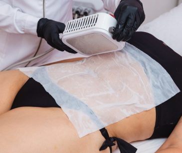 CoolSculpting procedure on woman’s abdomen using fat-freezing device