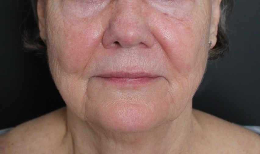 After: <p>71 yrs | 5'7 | 160 lbs | 1 year post-op</p><p>Erbium Laser Resurfacing (+ Fat Transfer to Face)</p>