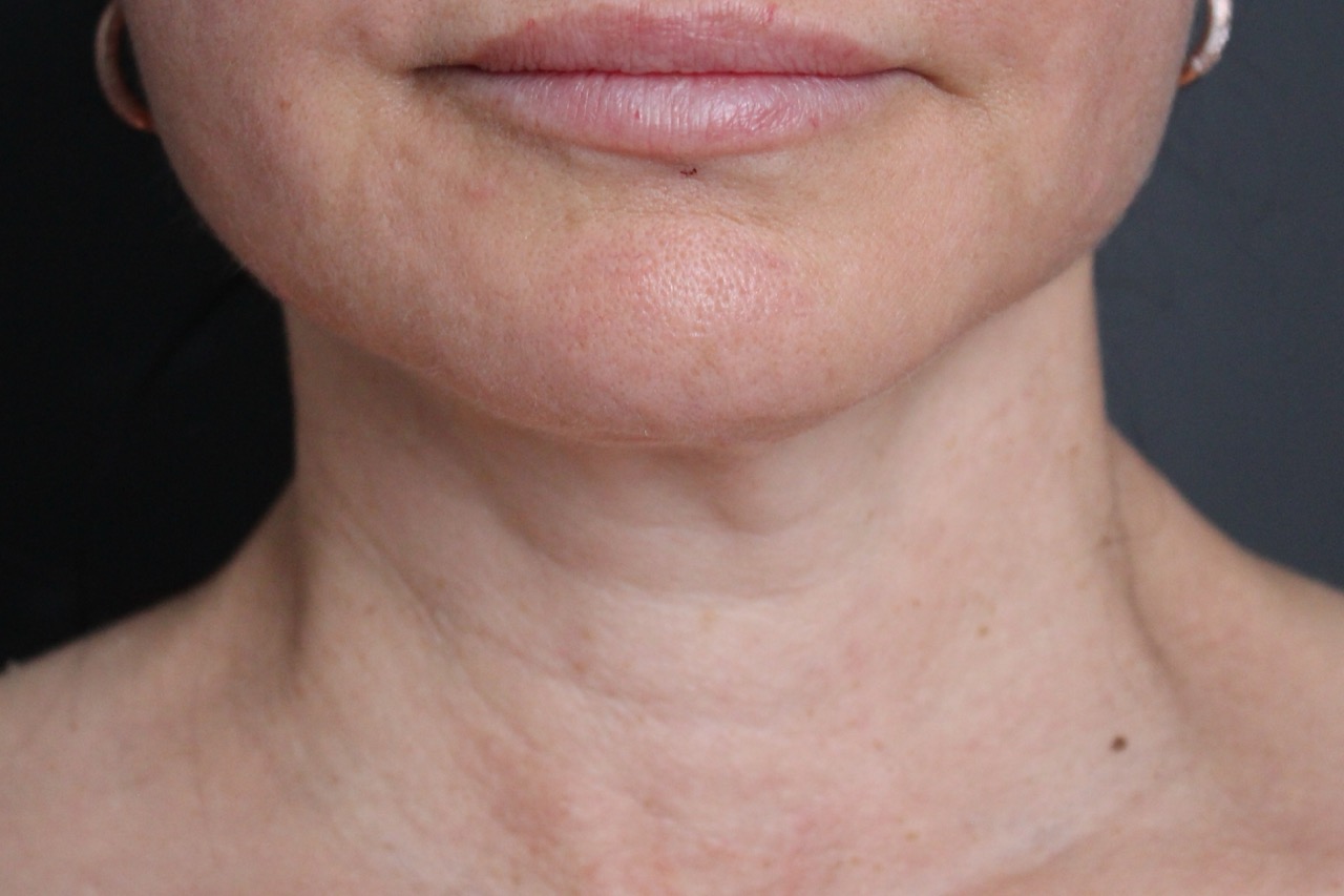After: <p>58 | 5'5 | 138lbs | 11 months post-op</p><p>Facelift, Open Necklift, Fat Transfer to Face, Radiofrequency Skin Tightening</p>
