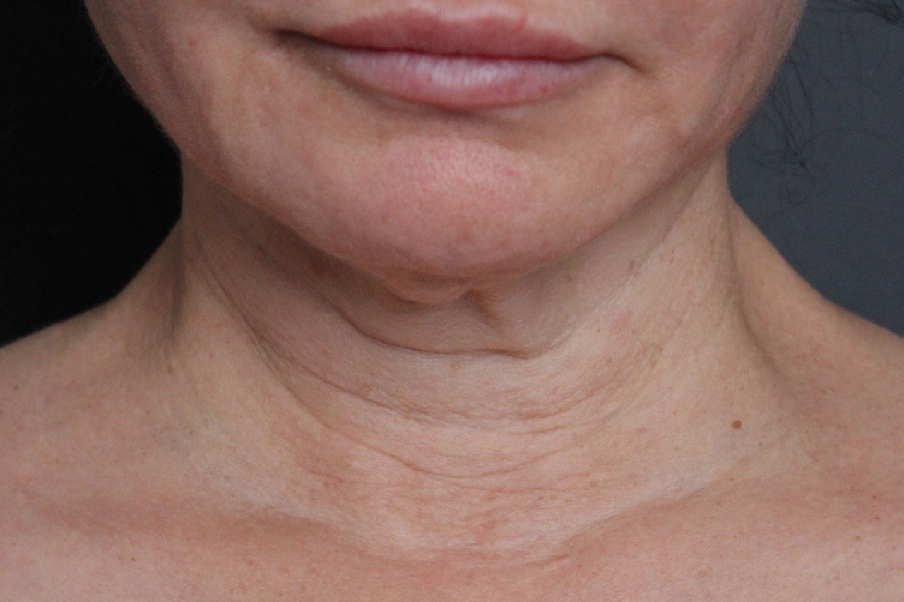 Before: <p>58 | 5'5 | 138lbs | 11 months post-op</p><p>Facelift, Open Necklift, Fat Transfer to Face, Radiofrequency Skin Tightening</p>
