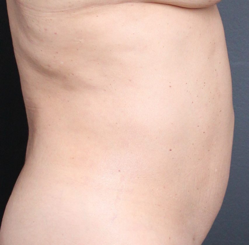 After: <p>51 yrs | 5'4 | 135lbs | 1 year post-op</p><p>Silhouette Vaser Liposuction with Radiofrequency Skin Tightening</p>