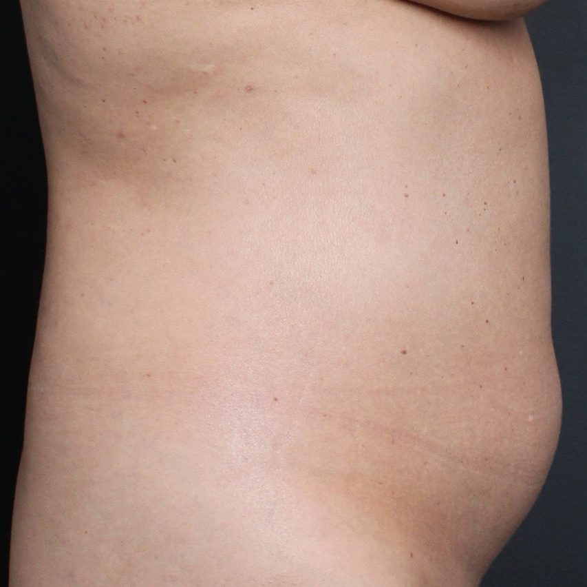 Before: <p>51 yrs | 5'4 | 135lbs | 1 year post-op</p><p>Silhouette Vaser Liposuction with Radiofrequency Skin Tightening</p>