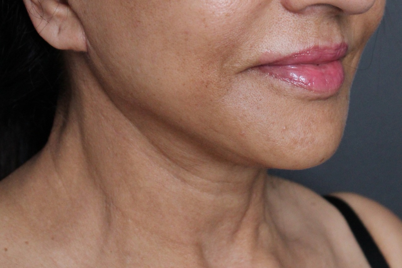 After: <p>63 yrs | 5'3 | 138lbs | 6 weeks post-op</p><p>Facelift with Open Necklift, Fat Transfer to Face, Radiofrequency Skin Tightening and Blepharoplasty</p>