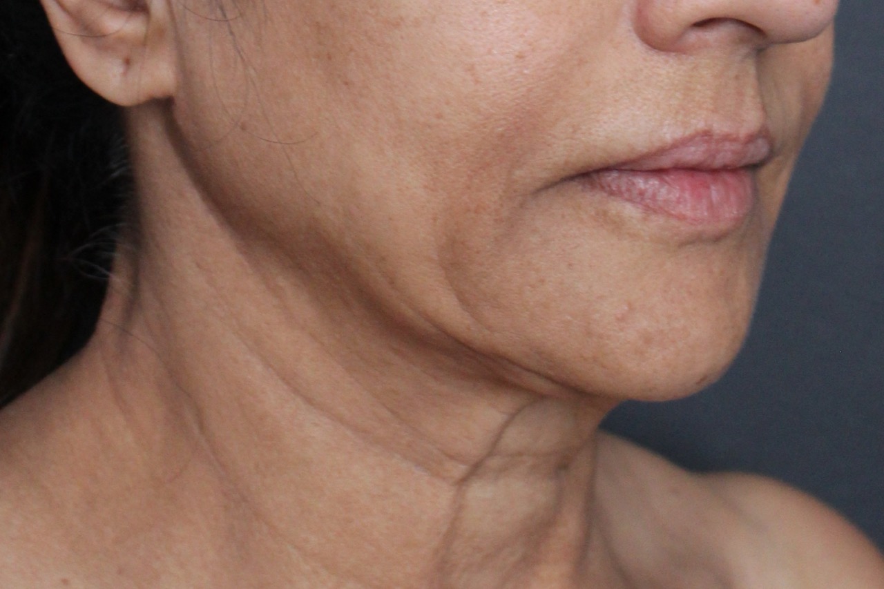 Before: <p>63 yrs | 5'3 | 138lbs | 6 weeks post-op</p><p>Facelift with Open Necklift, Fat Transfer to Face, Radiofrequency Skin Tightening and Blepharoplasty</p>