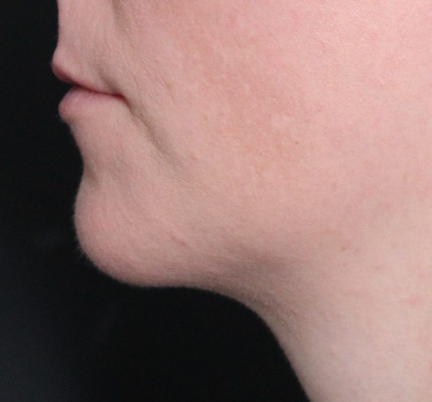 After: <p>36 yrs | 160lbs | 1 year post-op</p><p>Radiofrequency Skin Tightening with Submental Liposuction</p>