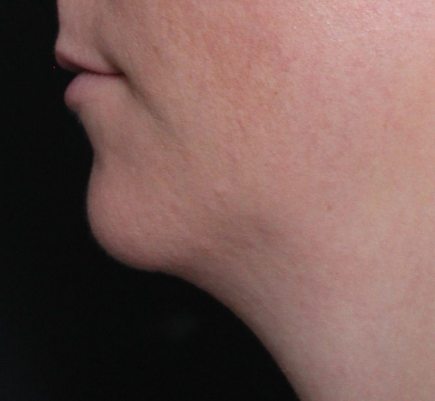 Before: <p>36 yrs | 160lbs | 1 year post-op</p><p>Radiofrequency Skin Tightening with Submental Liposuction</p>