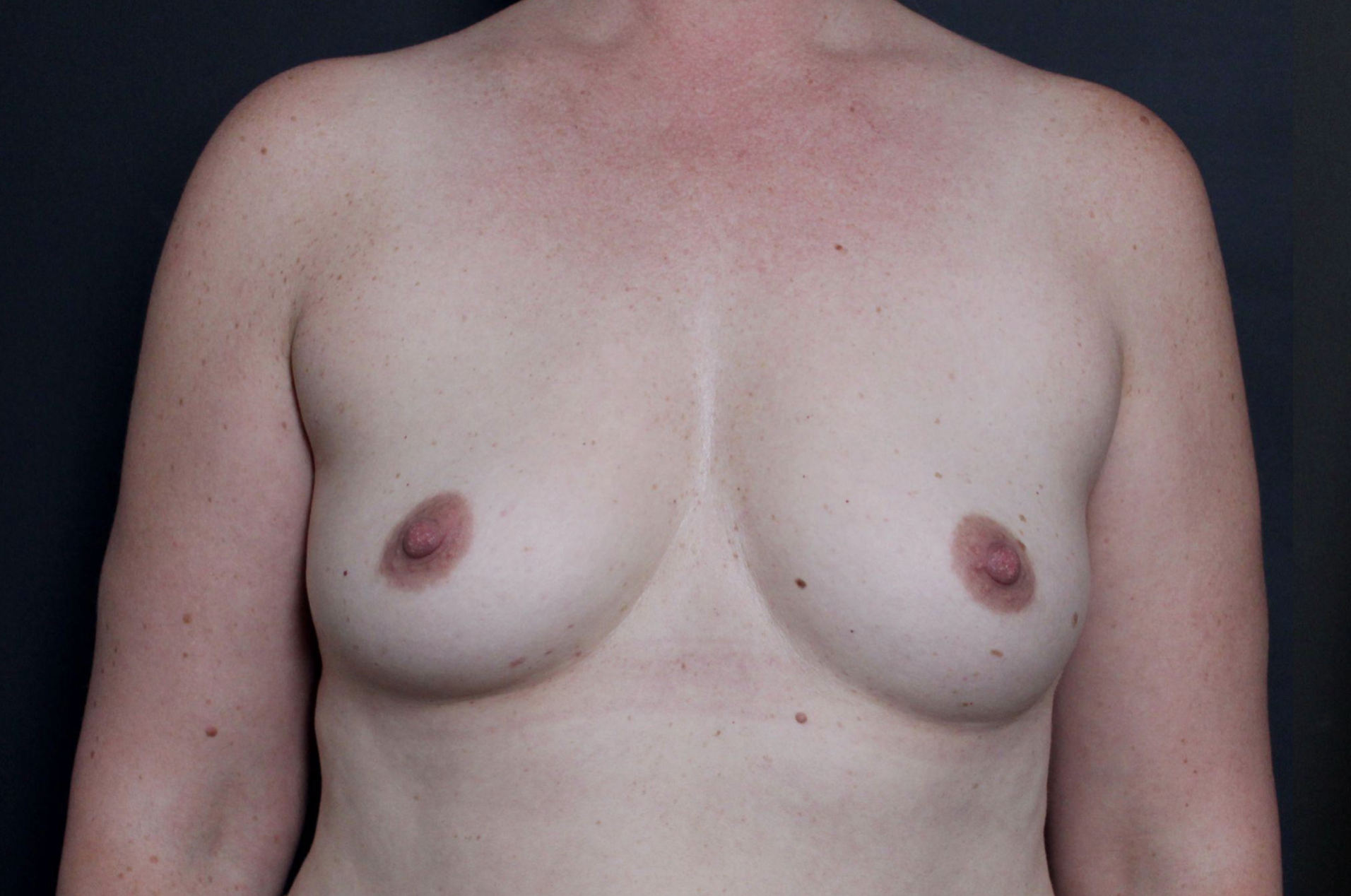 Pre-op photo after breast augmentation
