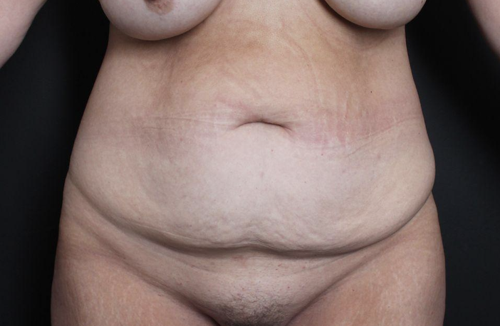 Pre-op abdominoplasty