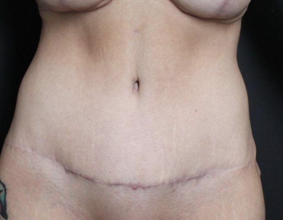 Post-op abdominoplasty