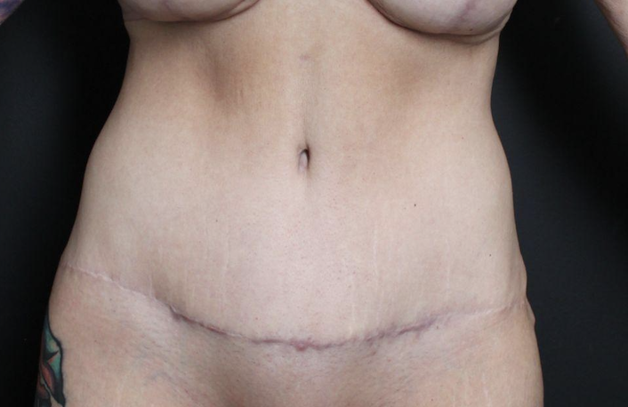 Post-op abdominoplasty