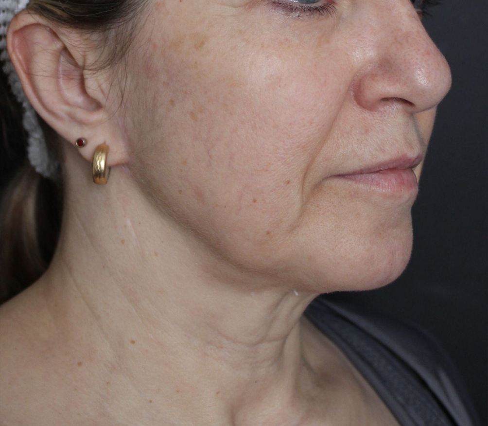 After: <p>58 yrs | 5'2 | 126lbs | 1 year 2 months post-op</p>