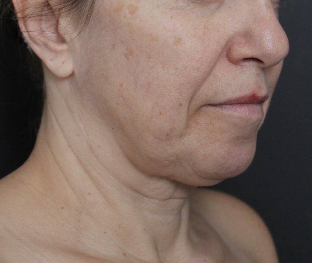 Before: <p>58 yrs | 5'2 | 126lbs | 1 year 2 months post-op</p>