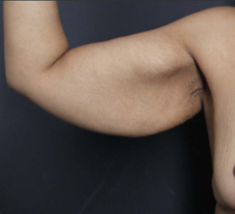 Before: <p>36 yrs | 5'7 | 176lbs | 6 months post-op</p><p>Brachioplasty with Vaser Liposuction and Radiofrequency Skin Tightening</p>