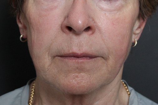 After: <p>68 yrs | 1 year post-op | Renuvion Skin Resurfacing</p>