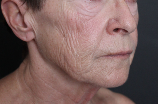 Before: <p>68 yrs | 1 year post-op | Renuvion Skin Resurfacing</p>