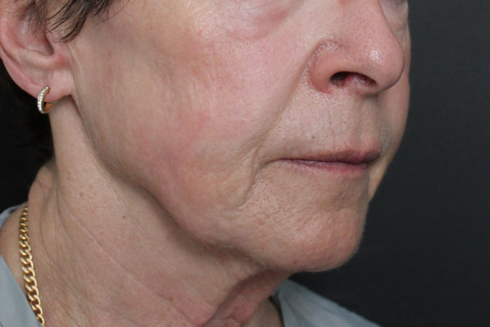 After: <p>68 yrs | 1 year post-op | Renuvion Skin Resurfacing</p>