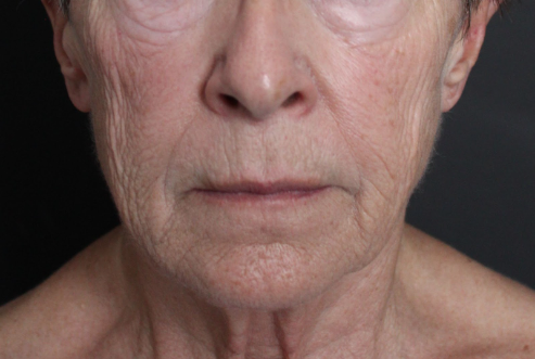 Before: <p>68 yrs | 1 year post-op | Renuvion Skin Resurfacing</p>