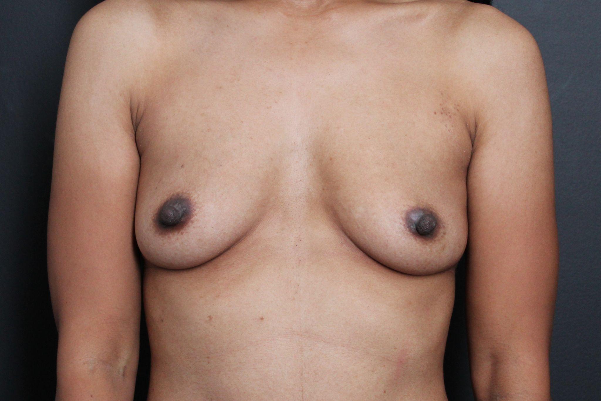 Pre-op photo after breast augmentation