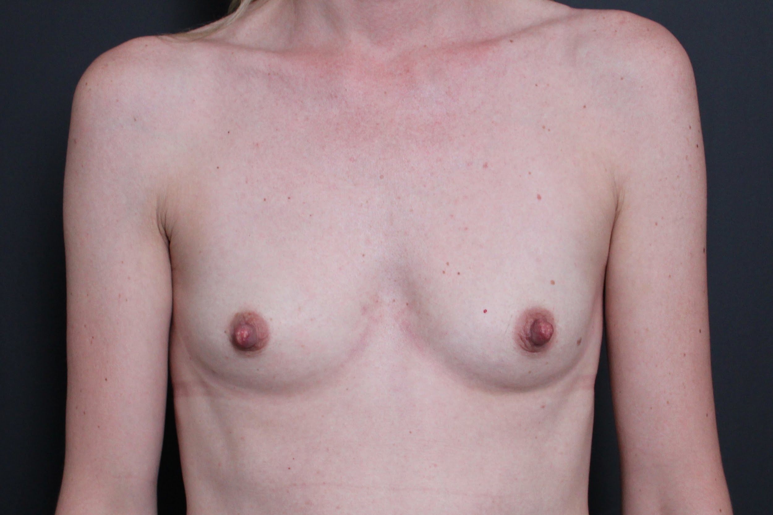 Pre-op photo after breast augmentation