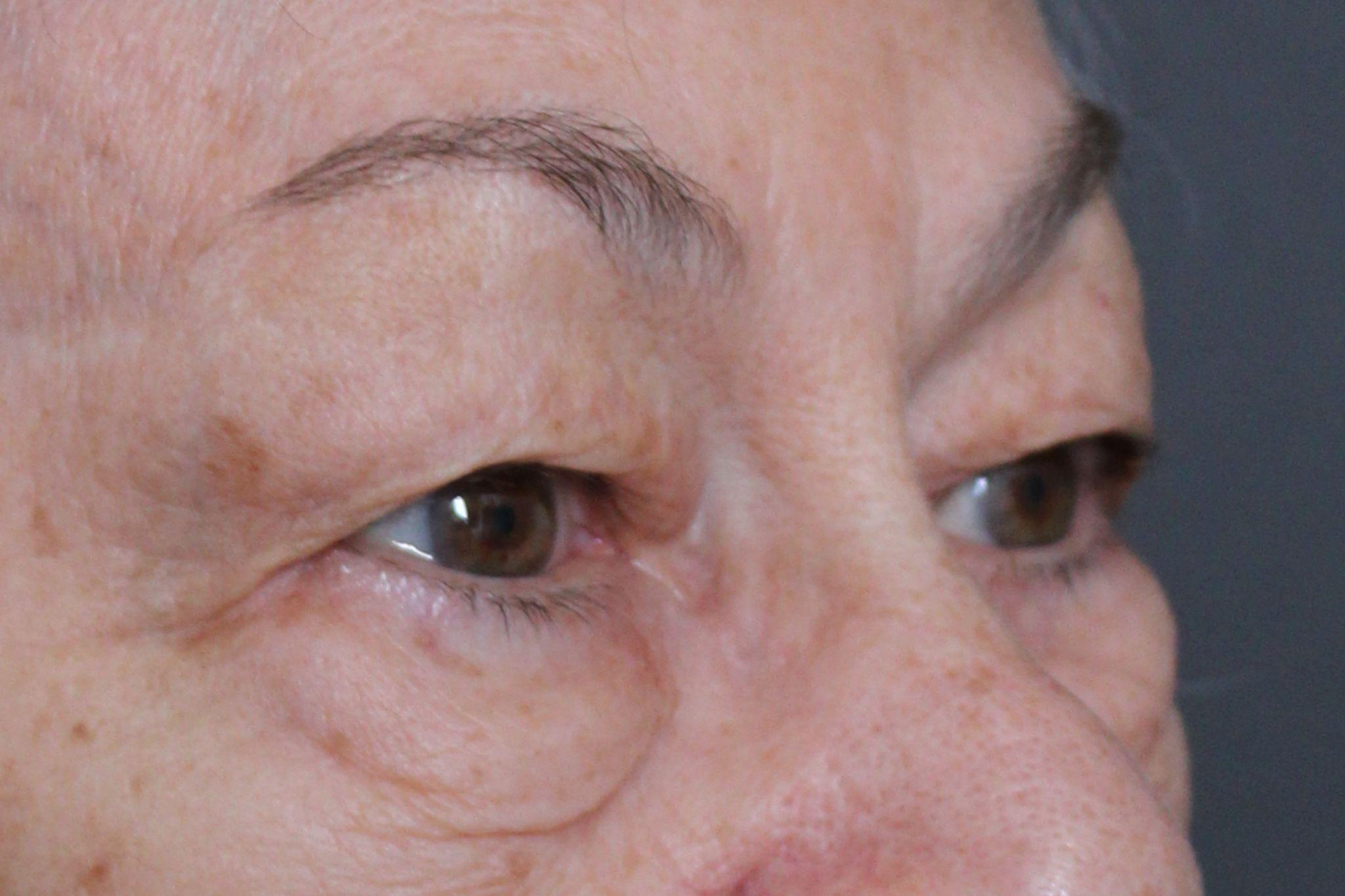 Pre-op blepharoplasty (upper/lower) with fat transfer to face