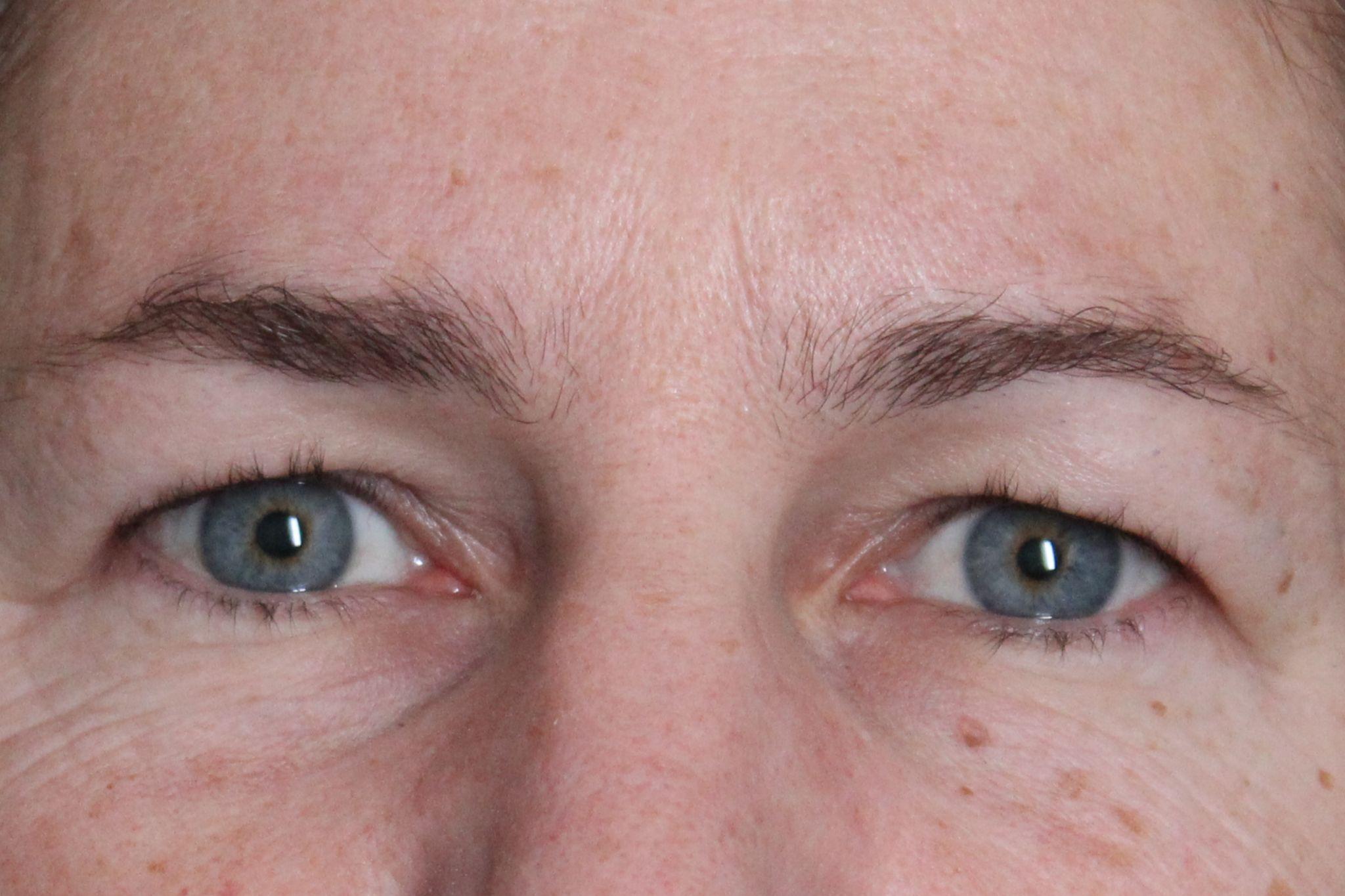 Pre-op blepharoplasty