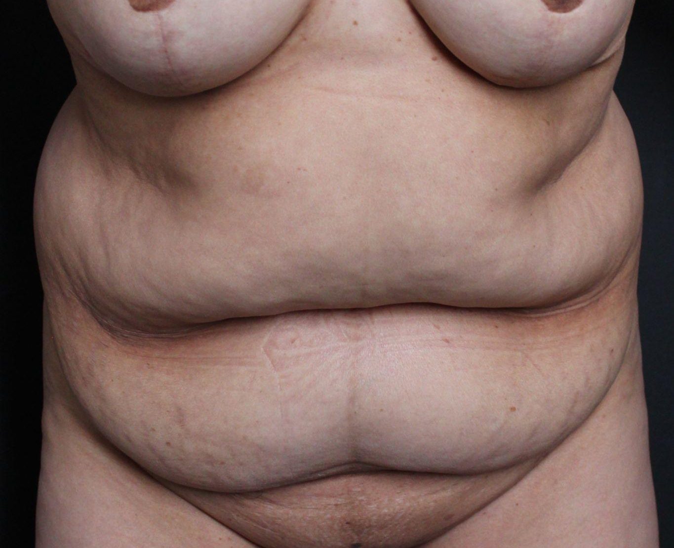 Pre-op abdominoplasty