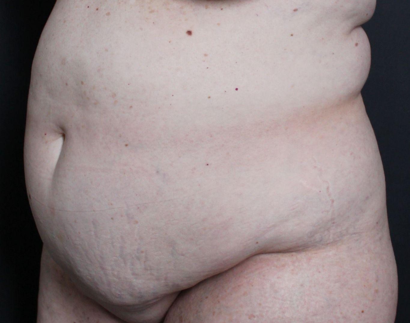 Pre-op abdominoplasty