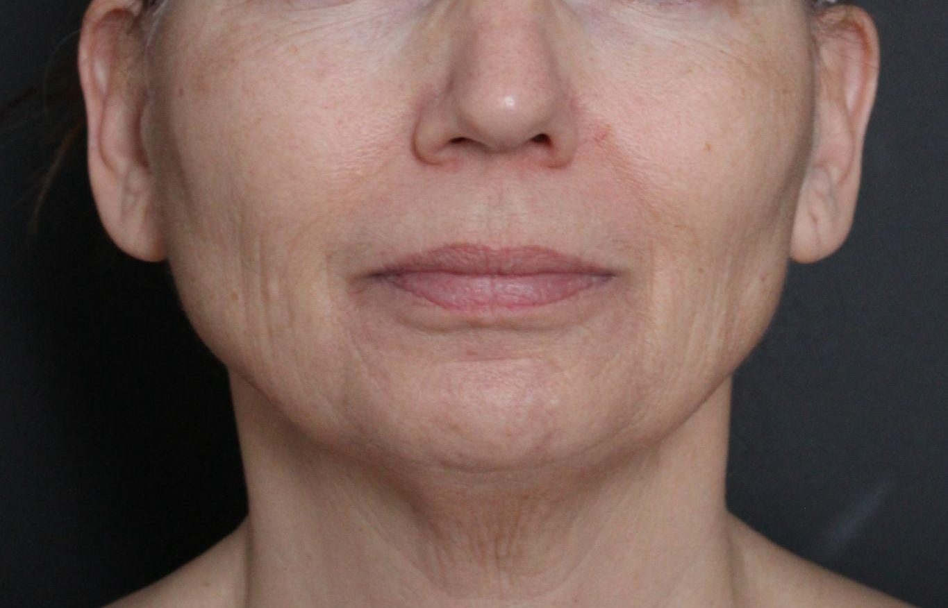 Before: <p>60 yrs | 5'4 | 145lbs | 6 months post-op</p><p>Laser Resurfacing (+ Facial Rejuvenation Surgery)</p>