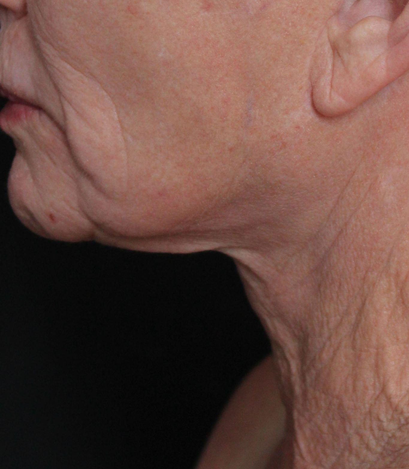 Before: <p>62 yrs | 5'3 | 133 | 6 weeks post-op</p><p>Facelift, Open Necklift, Radiofrequency Skin Tightening, Fat Transfer to Face, Blepharoplasty, Laser Resurfacing</p>