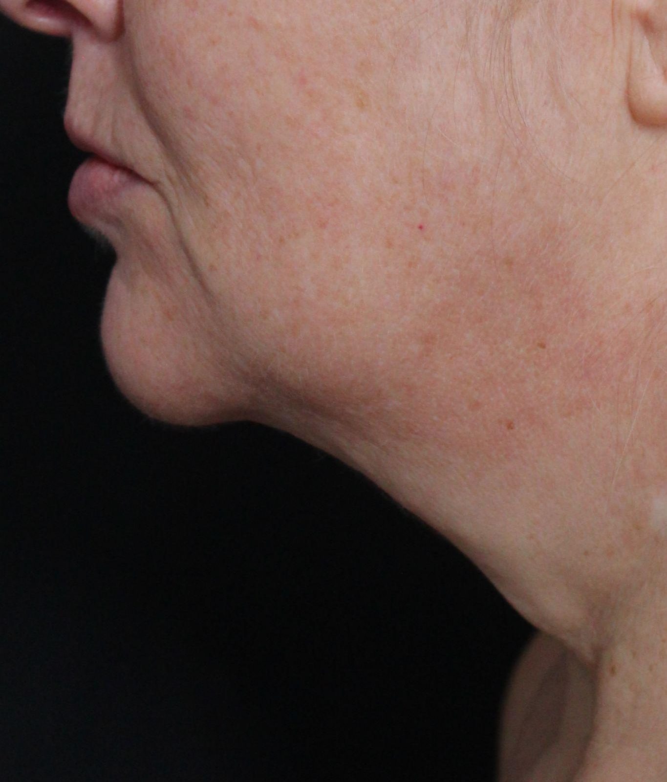 Before: <p>55 yrs | 5'6 | 150lbs | 1 year post-op</p><p>Facelift, Open Necklift, Radiofrequency Skin Tightening, Belpharoplasty, Fat Transfer to Face</p>