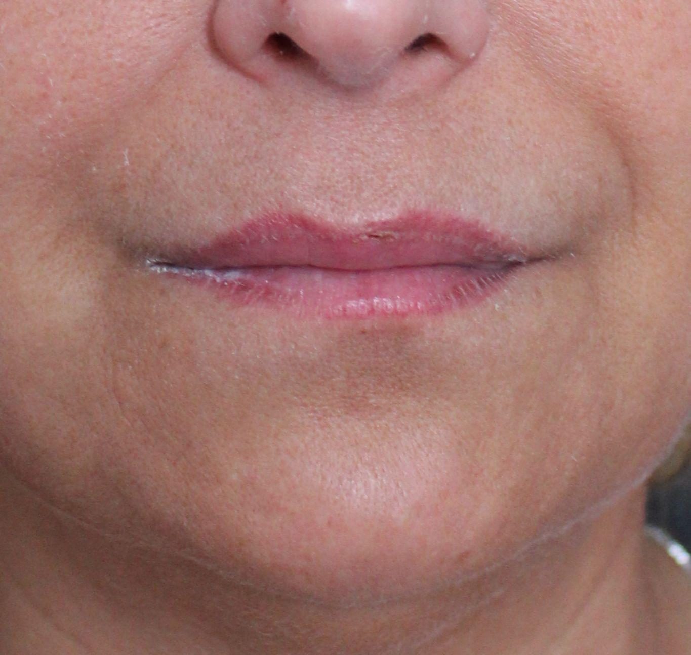 Before: <p>56 yrs | 5'5 | 152lbs | 6 months post-op</p><p>Fat Transfer to Full Face (with Facelift, Open Necklift, Radiofrequency Skin Tightening and Lip Lift)</p>