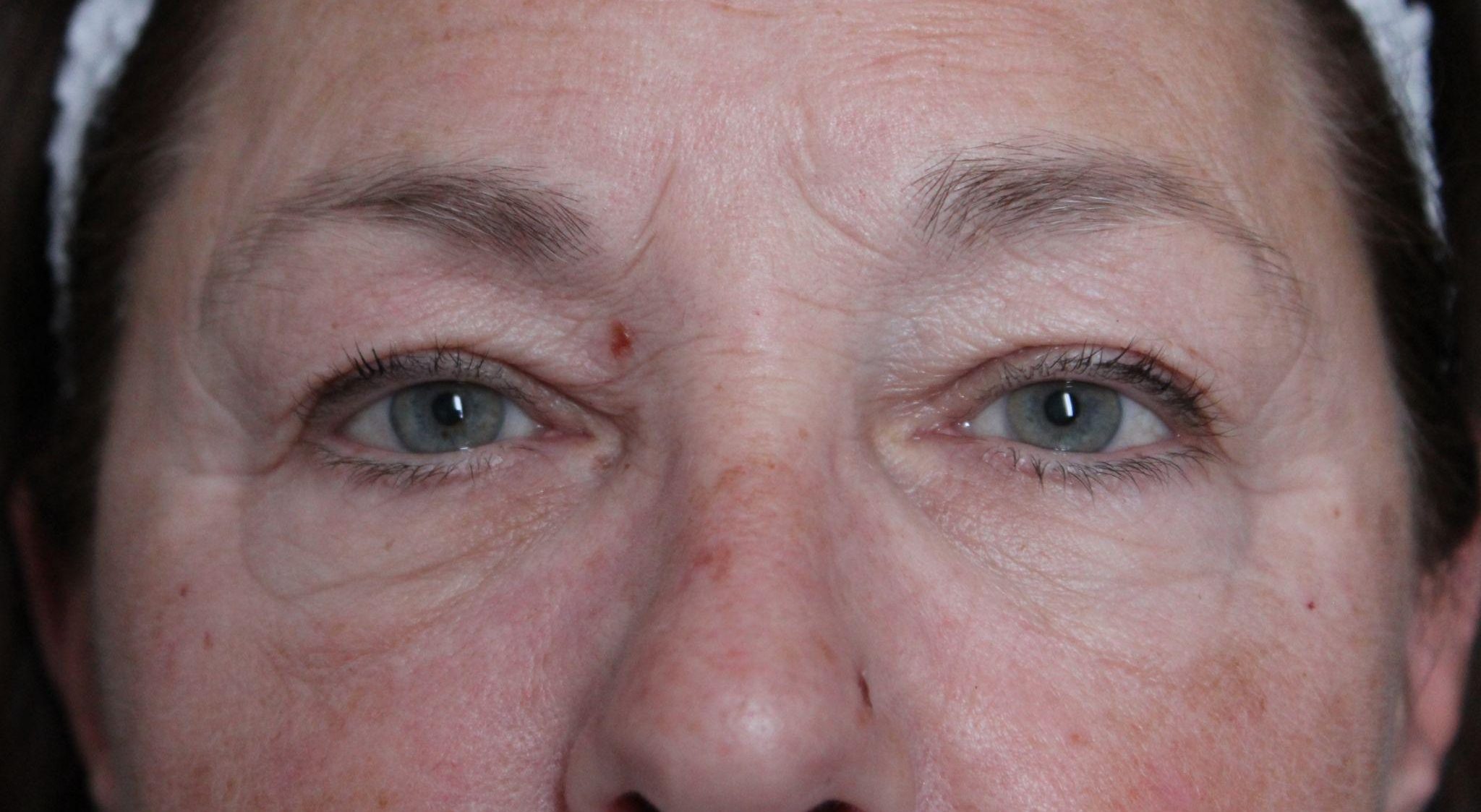 Before: <p>58 | 5'4 | 134 | 1 year 4 months post-op</p><p>Fat Transfer to Full Face (with Facelift, Open Necklift, Radiofrequency Skin Tightening, Upper and Lower Blepharoplasty)</p>