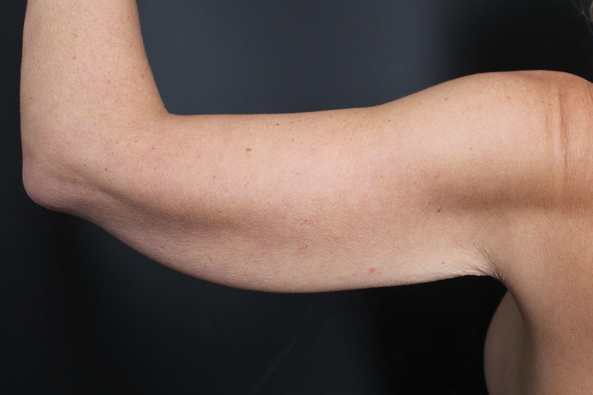 Before: <p>46 | 5'6 | 134lbs | 7 months post-op</p><p>Radiofrequency Skin Tightening (with Brachioplasty)</p>